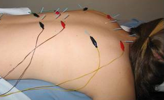Elektro Akupunktur Uygulaması